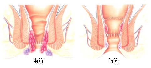 革命的な痔核無痛手術の画像